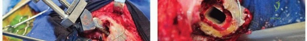 صورة توضيحية لـ مراجعة مفصل الورك بالإسمنت داخل الإسمنت: حلول متقدمة لعمليات استبدال الورك المعقدة مع الأستاذ الدكتور محمد هطيف