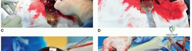 صورة طبية: مراجعة مفصل الورك بالإسمنت داخل الإسمنت: حلول متقدمة لعمليات استبدال الورك المعقدة مع الأستاذ الدكتور محمد هطيف