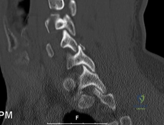 صورة توضيحية لعملية التصوير بالرنين المغناطيسي (MRI) لتشخيص حالات العمود الفقري