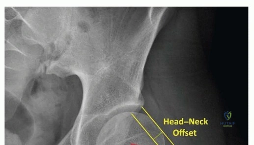 صورة توضيحية لـ استعادة صحة مفصل الفخذ جراحة قطع العظم الحوضي لعلاج خلل التنسج الحُقّي في صنعاء