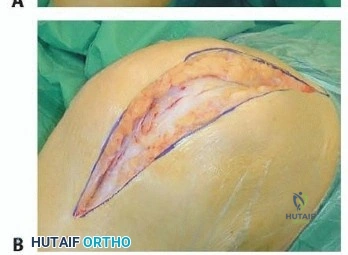 صورة توضيحية لـ قطع الحدبة الظنبوبية: دليل شامل لمرضى تبديل الركبة المراجع مع الأستاذ الدكتور محمد هطيف في صنعاء