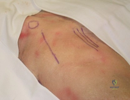 صورة طبية: استبدال مفصل الورك بالحد الأدنى من التدخل الجراحي: تقنيات متقدمة، فوائد وتحديات