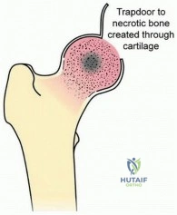 Illustration 8 for Head-Sparing for Osteonecrosis of the Femoral: Preserve Your Hip