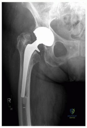 صورة طبية: إتقان مراجعة استبدال مفصل الورك: استراتيجيات تحديات الأنسجة المحلية الضارة