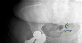 صورة توضيحية لـ جراحة استبدال مفصل الورك بالمدخل الأمامي المباشر بدون طاولة شد: دليل شامل للمرضى في صنعاء