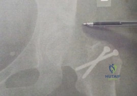 صورة طبية: خلع مفصل الورك الجراحي لعلاج الاحتكاك الفخذي الحقي: دليل شامل للمرضى