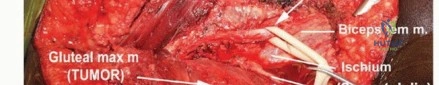 صورة طبية: ساركوما الأرداف: الحفاظ على العصب الوركي بدلاً من استئصال نصف الحوض مع الأستاذ الدكتور محمد هطيف