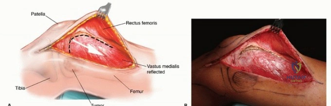 صورة توضيحية لـ النقائل العظمية الفخذية: دليل شامل للعلاج واستعادة الوظيفة مع الأستاذ الدكتور محمد هطيف في صنعاء