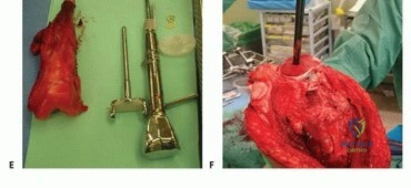 صورة توضيحية لـ الأطراف الصناعية القابلة للتمدد للأطفال: دليل شامل للمرضى حول الوقاية من العدوى والعلاج في صنعاء مع الأستاذ الدكتور محمد هطيف