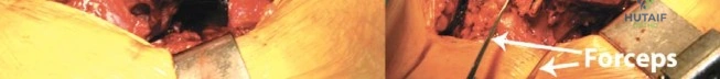 صورة طبية: ترميم سطح مفصل الورك بيرمنغهام: تقنية الجراح المصمم لحياة نشطة ومستقبل أفضل