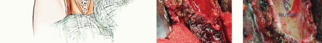 صورة طبية: جراحة نقائل عظم العضد: دليل شامل لاستعادة الوظيفة وتخفيف الألم في اليمن مع الأستاذ الدكتور محمد هطيف
