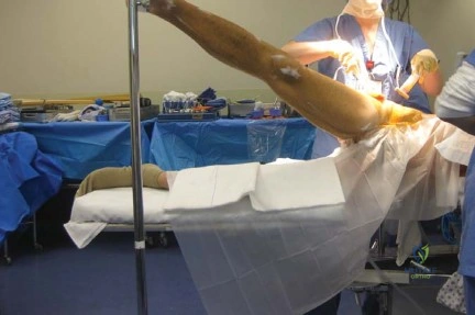 صورة أشعة سينية لمفصل ورك متضرر
