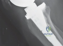 صورة طبية: إتقان موازنة الفجوة في مراجعة استبدال مفصل الركبة: تجنب الأخطاء الشائعة واستعادة الحركة مع الأستاذ الدكتور محمد هطيف