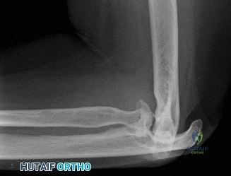 صورة طبية: دليلك الشامل لآلام ومشاكل الكتف والمرفق: التشخيص والعلاج مع الأستاذ الدكتور محمد هطيف في صنعاء