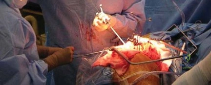 صورة طبية: تقليل المخاطر إلى الحد الأدنى: الملاحة الحاسوبية في جراحة استبدال سطح مفصل الورك
