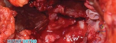صورة توضيحية لـ إدارة كسور الحوض حول المفصل الصناعي: دليل جراحي شامل للمرضى بقلم الأستاذ الدكتور محمد هطيف