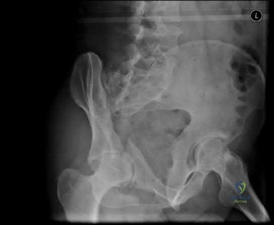 صورة طبية: دليل شامل لكسور وإصابات الجهاز الحركي: رعاية متقدمة في صنعاء مع الأستاذ الدكتور محمد هطيف