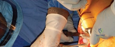 زرع مفصل المراجعة ذو السيقان الطويلة