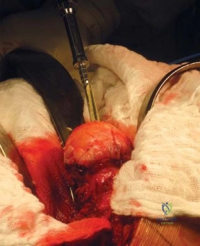 صورة طبية: إعادة تسطيح مفصل الورك المعدني: تقنية جراحية متقدمة مع إصلاح الأنسجة الرخوة الخلفية المعزز على يد الأستاذ الدكتور محمد هطيف في صنعاء