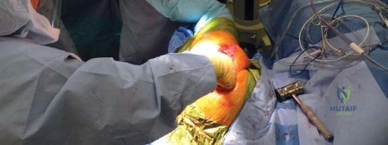 صورة توضيحية لعملية استبدال مفصل الورك
