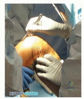 صورة توضيحية لـ جراحة استبدال مفصل الركبة الكلي بالأسمنت: حل دائم لتخفيف الألم واستعادة الحركة مع الأستاذ الدكتور محمد هطيف في صنعاء