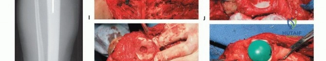 صورة طبية: استئصال عظم الفخذ البعيد المتقدم: جراحة الحفاظ على الأطراف ونتائجها في صنعاء مع الأستاذ الدكتور محمد هطيف
