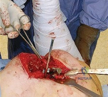 صورة توضيحية لـ النهج الخلفي لمفصل الورك: دليل شامل لاستعادة الحركة في صنعاء مع الأستاذ الدكتور محمد هطيف