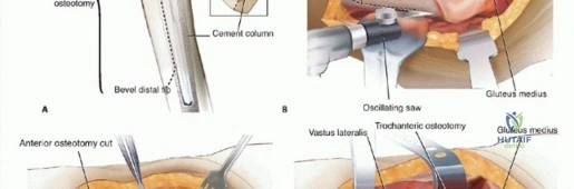 صورة توضيحية لـ مراجعة استبدال مفصل الورك الكلي: دقة إزالة المكونات الثابتة والحفاظ على العظم مع الأستاذ الدكتور محمد هطيف