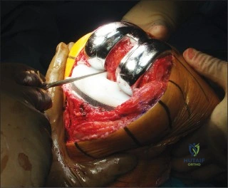 صورة توضيحية لـ استبدال مفصل الركبة مع الحفاظ على الرباط الصليبي الخلفي: دليل شامل للمرضى في صنعاء مع الأستاذ الدكتور محمد هطيف