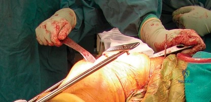 صورة توضيحية لـ سيقان الفخذ اللاأسمنتية: دليل شامل للمرضى ودواعي الاستخدام ومزاياها في صنعاء