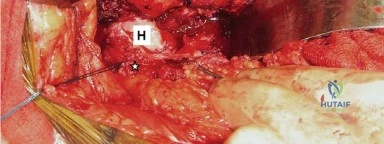 صورة توضيحية لـ إتقان توازن الأنسجة الرخوة لمفصل ورك صناعي مثالي: دليل شامل للمرضى مع الأستاذ الدكتور محمد هطيف