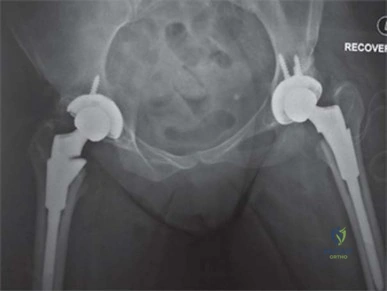 صورة طبية: استبدال مفصل الورك الكلي الناجح في خلل التنسج النمائي للورك: دليل شامل من الأستاذ الدكتور محمد هطيف