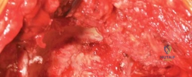 صورة توضيحية لـ مدخل هاردينج المعدل لجراحة الورك: دليل شامل لاستبدال مفصل الورك في صنعاء