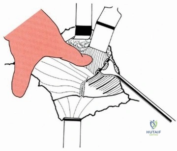 صورة طبية: قطع العظم المدوري الانزلاقي: دور حديث وتقنيات متطورة لاستعادة حركة الورك