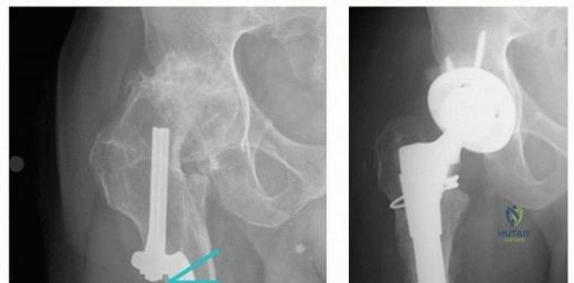 صورة طبية: التغلب على تشوهات الفخذ القريب في جراحة استبدال مفصل الورك الكلي: استراتيجيات متقدمة مع الأستاذ الدكتور محمد هطيف
