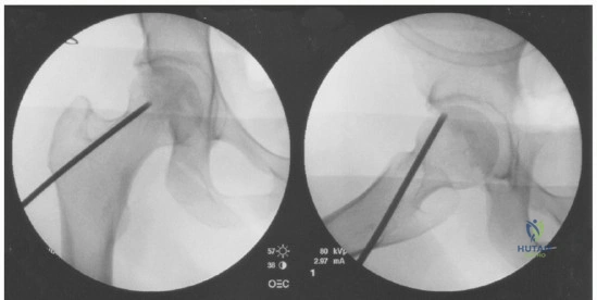 Illustration 3 for Head-Sparing for Osteonecrosis of the Femoral: Preserve Your Hip