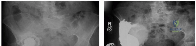 صورة طبية: الأجهزة ثلاثية الشفاه المخصصة: حل مبتكر لفقدان عظم الحوض الشديد واستعادة وظيفة مفصل الورك