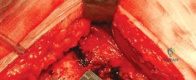 صورة طبية: النهج الخلفي الجانبي المتقدم: تحقيق أفضل النتائج في جراحة استبدال مفصل الورك الكلي مع الأستاذ الدكتور محمد هطيف في صنعاء