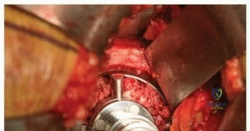 صورة طبية: تثبيت مفصل الورك بدون أسمنت: دليل شامل لمرضى استبدال الورك مع الأستاذ الدكتور محمد هطيف