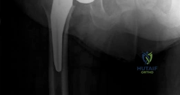 صورة توضيحية لـ جراحة استبدال مفصل الورك بالمدخل الأمامي المباشر بدون طاولة شد: دليل شامل للمرضى في صنعاء