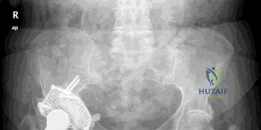 صورة توضيحية لـ جراحة مفصل الورك المراجع وزراعة العظم الحوضي: حلول متقدمة لآلام الورك المزمنة
