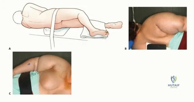 صورة توضيحية لعملية البتر والتشريح الجراحي