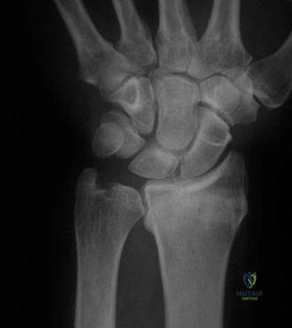 صورة توضيحية لـ علاج كسور الرسغ المعقدة: دليلك الشامل مع الأستاذ الدكتور محمد هطيف في صنعاء