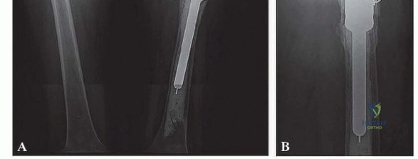 صورة توضيحية لـ إنقاذ الأطراف: أحدث التطورات في استبدال الجزء العلوي من عظم الفخذ