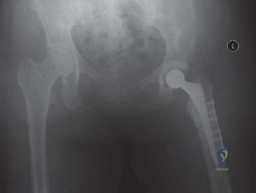 صورة طبية: استبدال مفصل الورك الكلي الناجح في خلل التنسج النمائي للورك: دليل شامل من الأستاذ الدكتور محمد هطيف