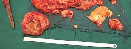 صورة طبية: جراحة استبدال مفصل الورك الملتهب في مرحلة واحدة: حل فعال وشامل مع الأستاذ الدكتور محمد هطيف