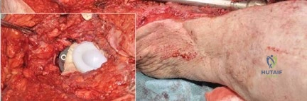 صورة طبية: جراحة استبدال مفصل الورك الملتهب في مرحلة واحدة: حل فعال وشامل مع الأستاذ الدكتور محمد هطيف
