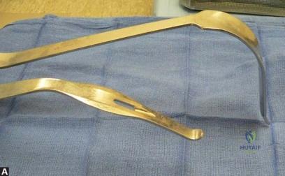 صورة طبية: استبدال مفصل الورك الكلي في العيادات الخارجية: دليل شامل من الأستاذ الدكتور محمد هطيف في صنعاء