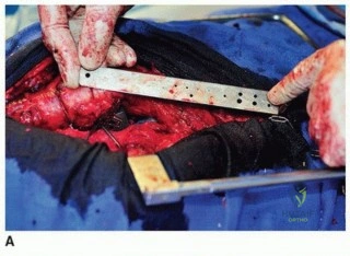 صورة طبية: مراجعة مفصل الورك بالإسمنت داخل الإسمنت: حلول متقدمة لعمليات استبدال الورك المعقدة مع الأستاذ الدكتور محمد هطيف