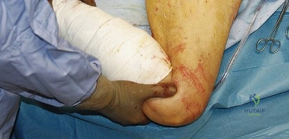 صورة طبية: النهج الخلفي لمفصل الورك: دليل شامل لاستعادة الحركة في صنعاء مع الأستاذ الدكتور محمد هطيف